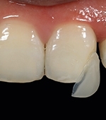 Riabilitazione minimamente invasiva di un difetto del bordo incisale con ceramica ibrida CAD/CAM