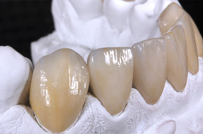 Veneers und Vollkronen aus VITA AMBRIA und VITA LUMEX AC
