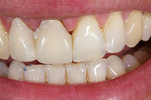The provisionally restored incisors 11 and 12 after removal of the previous restorations.