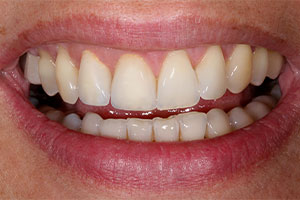 The incisors in the second quadrant had been reproduced to look natural.