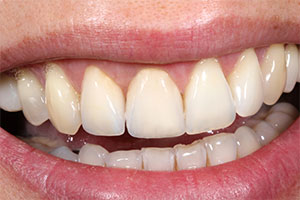 The all-ceramic crowns reproduced the basic tooth shade, the three-dimensional anatomy and natural effects.