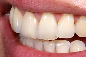 The patient was very happy with the highly esthetic result.