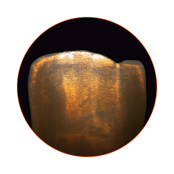 Jeu de couleurs brillant d'une restauration en céramique pressée VITA