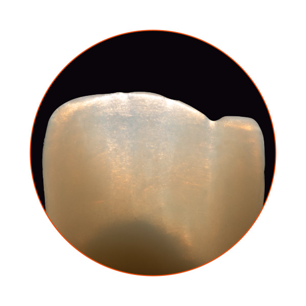 Affascinante trasmissione della luce di un restauro in ceramica pressabile VITA