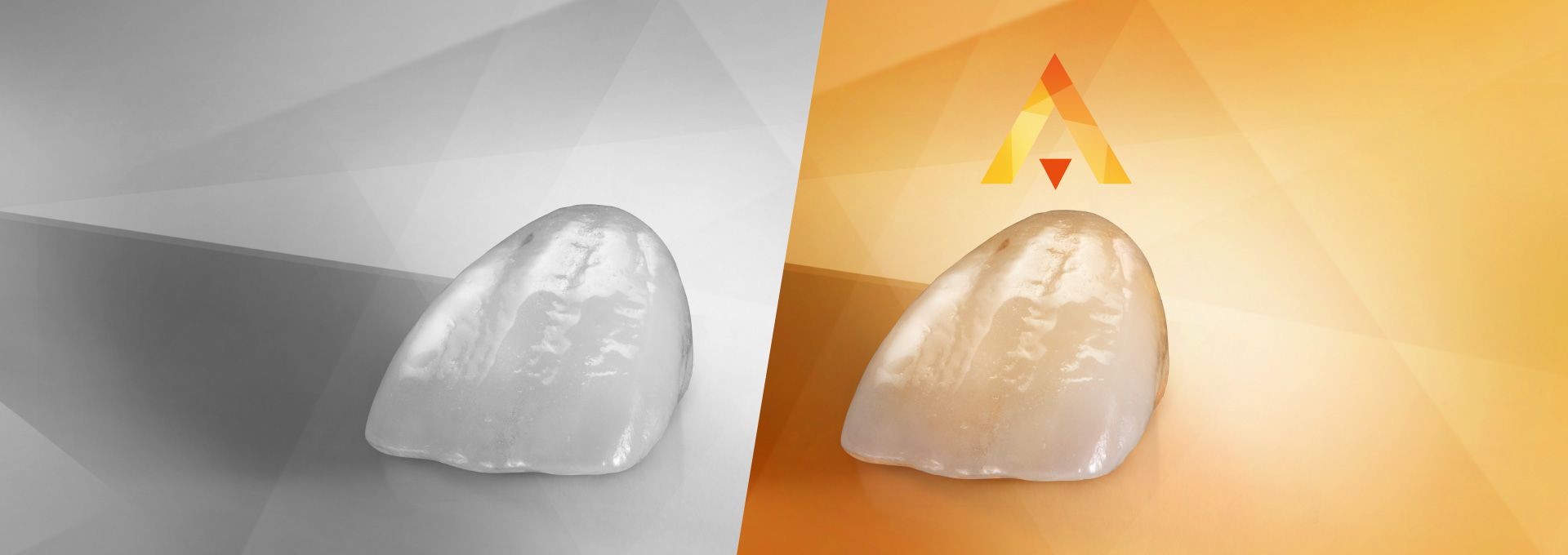 Anterior tooth crown made of VITA AMBRIA Press Ceramic