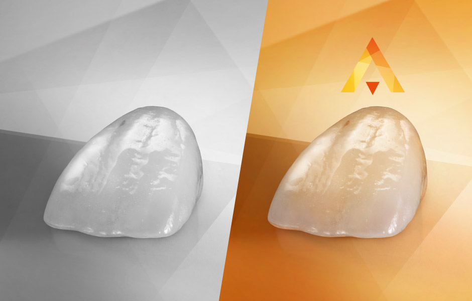 Anterior tooth crown made of VITA AMBRIA Press Ceramic
