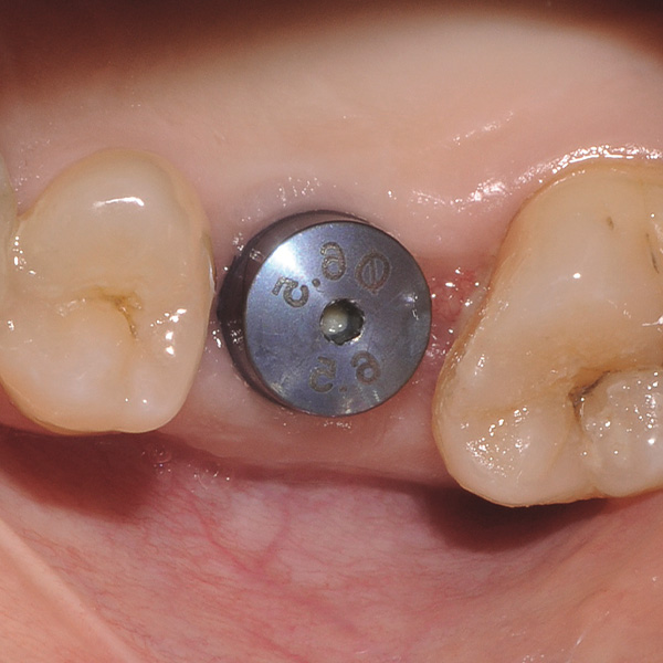 Ausgangssituation: Das Implantat an 26 nach einer Einheilzeit von drei Monaten.