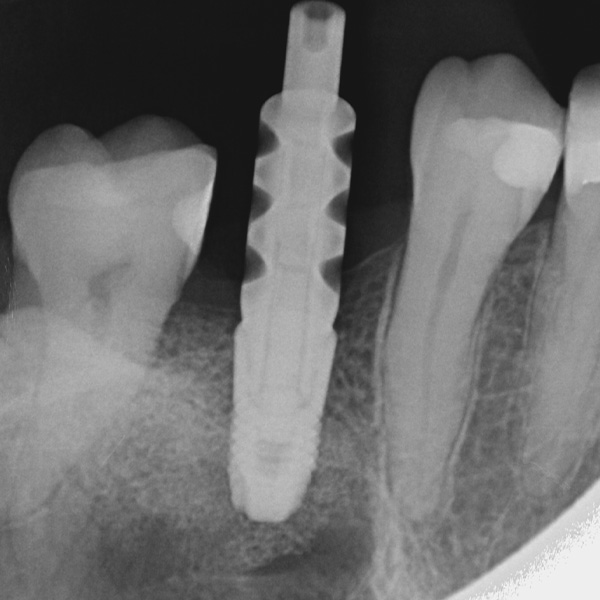 Das osseointegrierte Implantat mit aufgeschraubtem Abformpfosten.