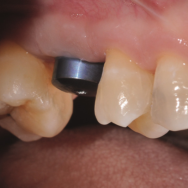 The soft tissue conditions around the gingiva former were stable and inflammation-free.