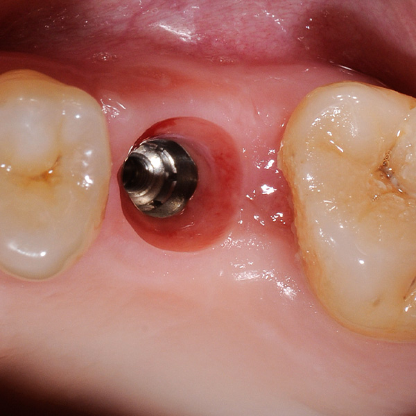 After the gingiva former was unscrewed, the shaped emergence profile was revealed.