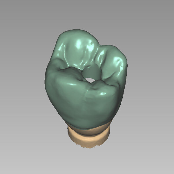 An abutment crown with screw channel was designed using CAD software.