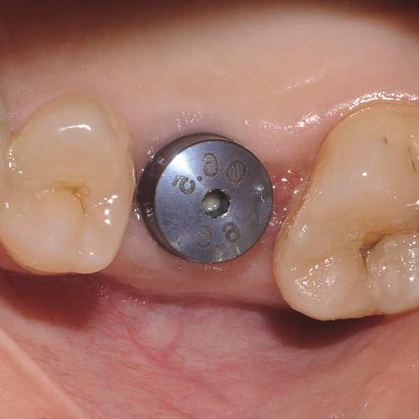 Situación de partida: El implante en el diente 26 tras un periodo de cicatrización de tres meses.