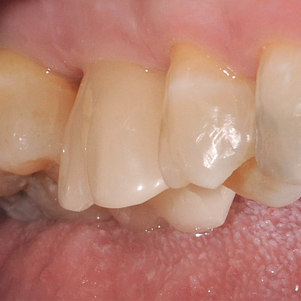 Résultat : La couronne pilier s’est harmonieusement intégrée aux dents naturelles.