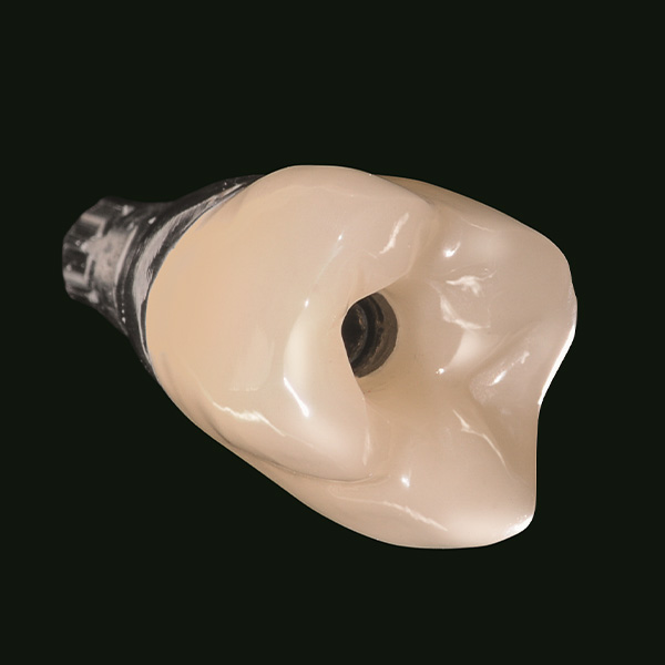 Corona-abutment fissata con tecnica adesiva sull’abutment individuale.