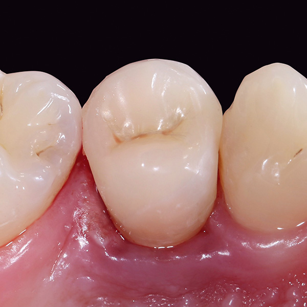 Direkt nach der definitiven Eingliederung war die Gingiva noch irritiert und entzündet.