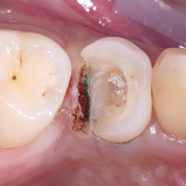 Um die Blutung zu stillen, wurde distal gingivektomiert und ein Retraktionsfaden eingelegt.