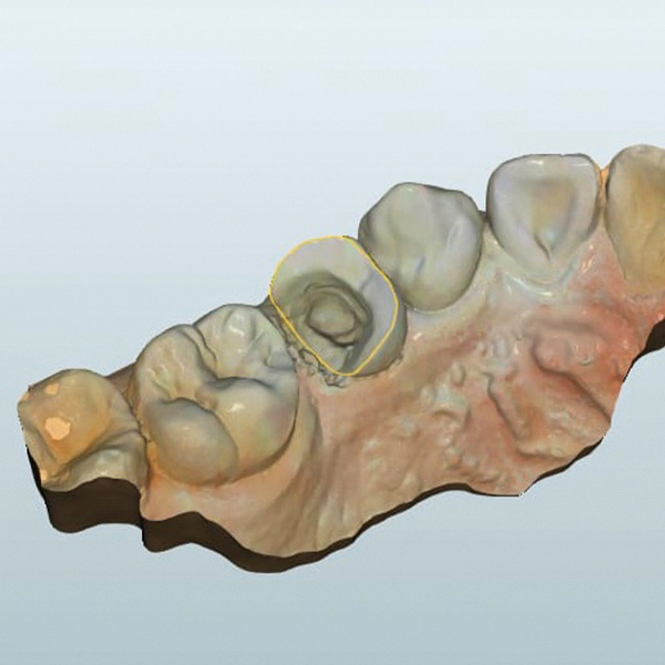 Auf der Basis des intraoralen Scans wurde ein virtuelles Modell für die Konstruktion erstellt.