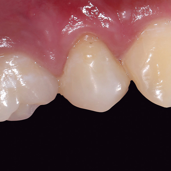 During the follow-up after three months, healthy gingival conditions appeared.