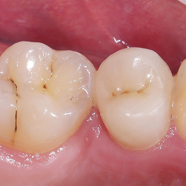 RESULT: VITA ENAMIC multiColor integrated perfectly into the natural tooth substance.