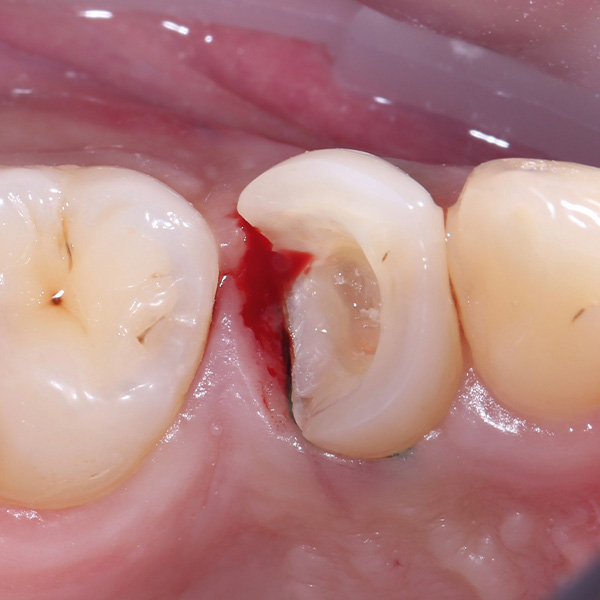 After removal of the composite filling, inflammatory bleeding of the gingiva appeared on the proximal box.
