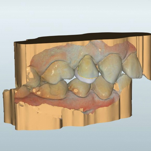 The finished virtual design of the endocrown restoration in the vestibular view.