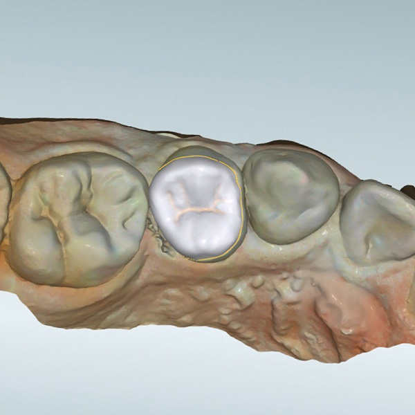 The virtual design in occlusal view before nesting in the virtual block.