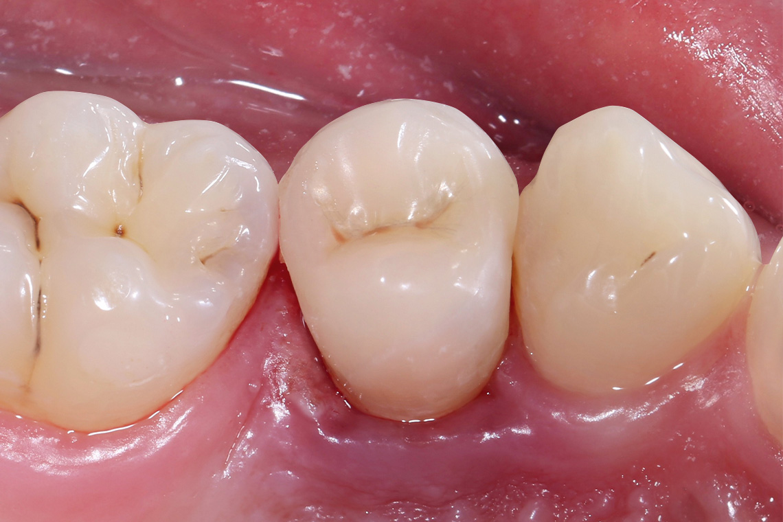 RESULT: VITA ENAMIC multiColor integrated perfectly into the natural tooth substance.