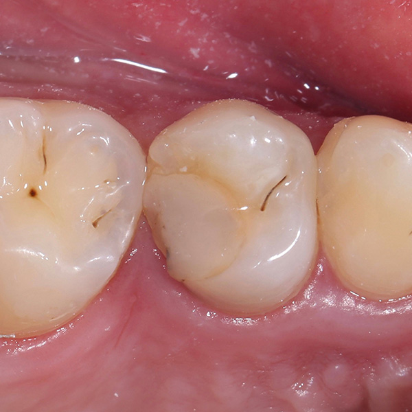 La obturación de composite insuficiente en el diente 14 (od) había provocado inflamaciones en el espacio interdental.