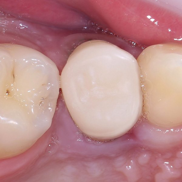La restauración confeccionada mediante CAD/ CAM, durante la prueba clínica en boca tras el acabado.