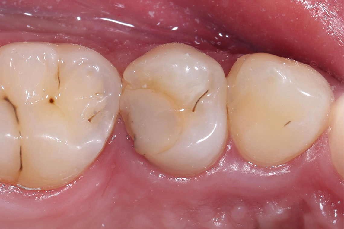 La obturación de composite insuficiente en el diente 14 (od) había provocado inflamaciones en el espacio interdental.