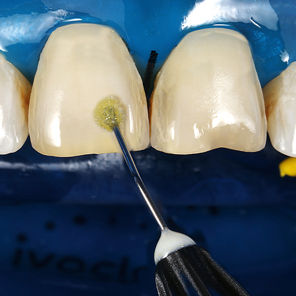 Auf die Zahnoberflächen wurde ein lichthärtendes Einkomponentenadhäsiv appliziert.