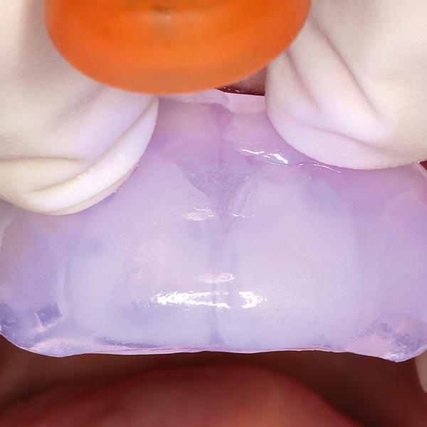 Mit einem transparenten Silikonschlüssel und lichthärtendem Komposit wurde das Mock-up intraoral gefertigt.