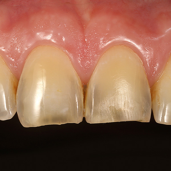 Initial situation: Erosion and abrasion led to a shortened incisor and the loss of the morphology of teeth 11 and 21.