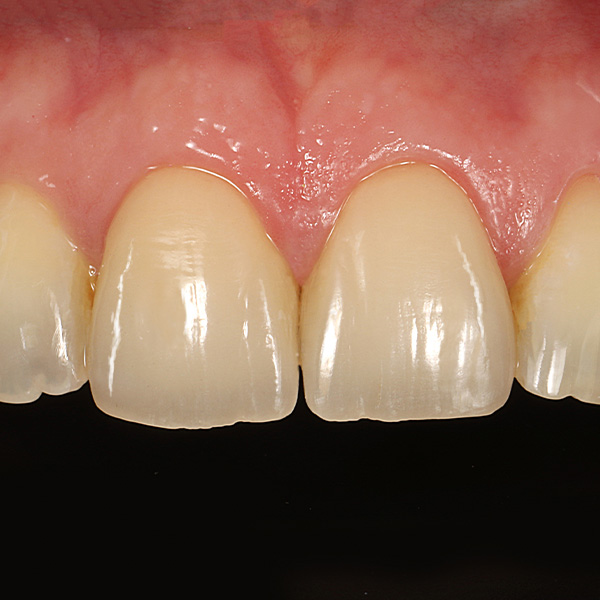 Both veneers integrated completely and naturally into the esthetic zone.
