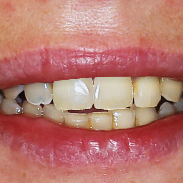 With the software Smile Designer Pro, ideal middle incisors were constructively simulated.