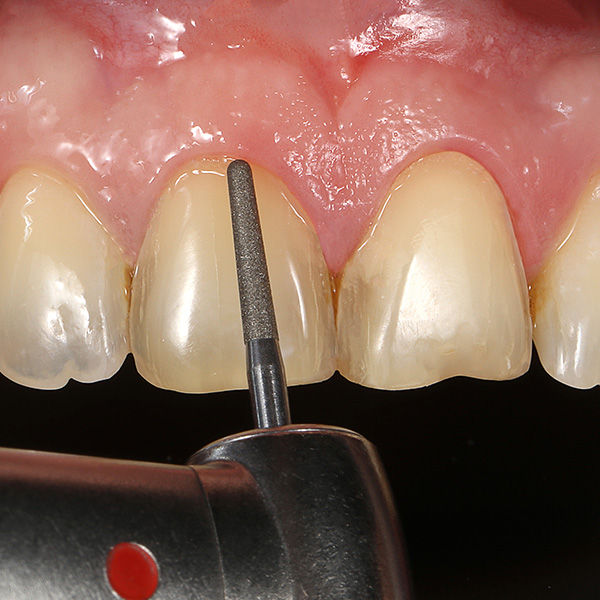 The minimally invasive preparation during the application of a micro chamfer in the cervical area.