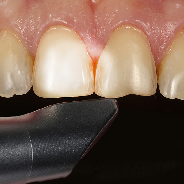 The clinical situation was scanned with the CEREC Omnicam.