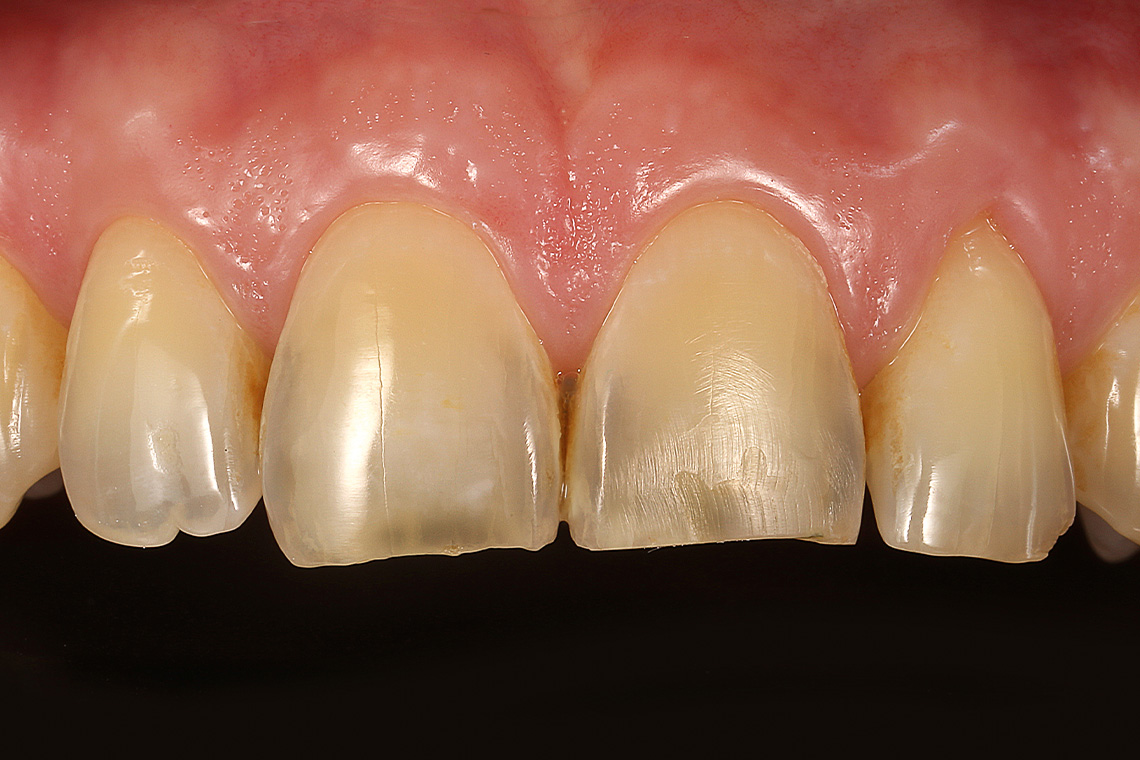 Initial situation: Erosion and abrasion led to a shortened incisor and the loss of the morphology of teeth 11 and 21.