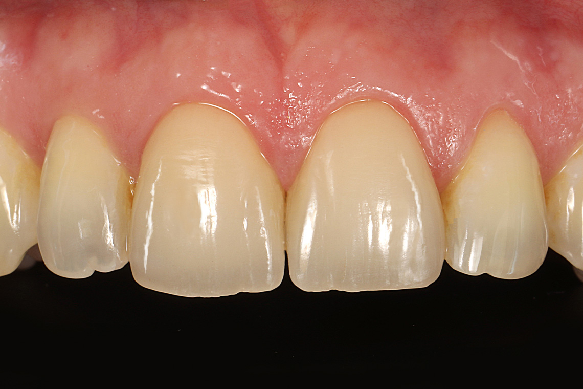 Result: The curve of the incisal edges harmonized with the curve of the lips.