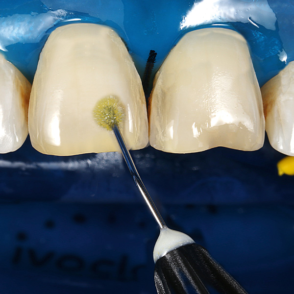 Un adhésif monocomposant photopolymérisable a été appliqué sur la surface des dents.