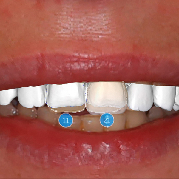L'application CEREC Smile Design a évalué l'aspect des restaurations par rapport aux lèvres de la patiente.