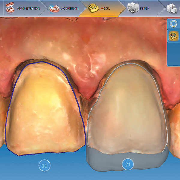 Design delle faccette in ceramica ibrida nel CEREC-Software.