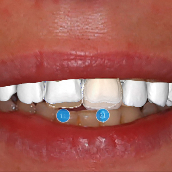 Con l'applicazione CEREC-Smile Design i restauri possono essere valutati insieme alle labbra.