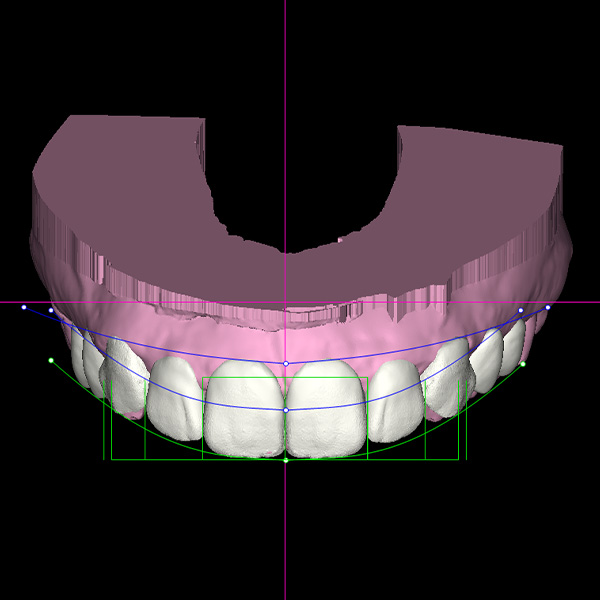 Das extrahierte virtuelle Wax-up-Modell vorbereitet zum 3D-Druck.