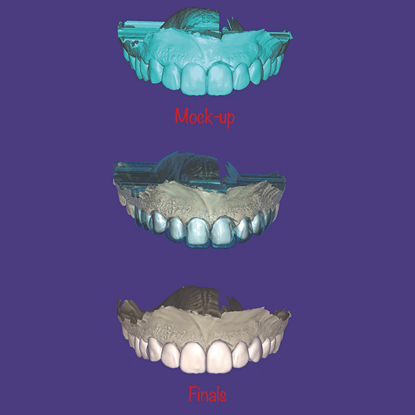 Abgleich des virtuelle Wax-up mit dem Scan der Präparation, um die Veneers in der CAD-Software zu konstruieren.