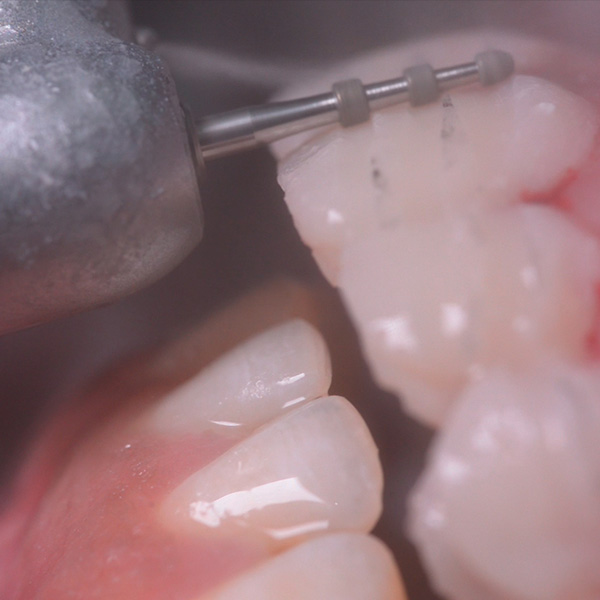 A guided mock-up preparation provided a controlled and minimally invasive removal of enamel.