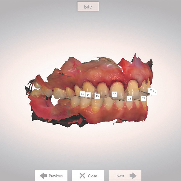 After the preparation, another intraoral scan was performed.