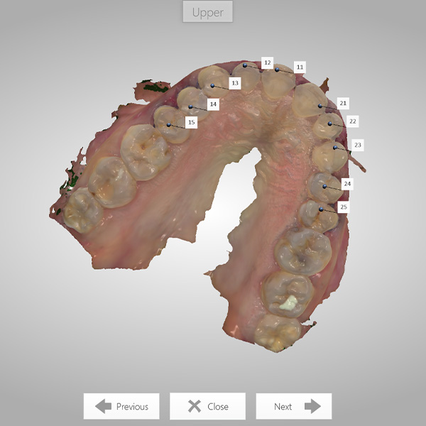 The cranial view shows how minimally invasive the guided mock-up preparation could be performed.