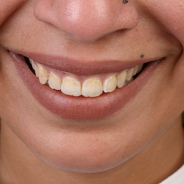 Generally, the contours of the incisal edges were in harmony with the lower lip line.