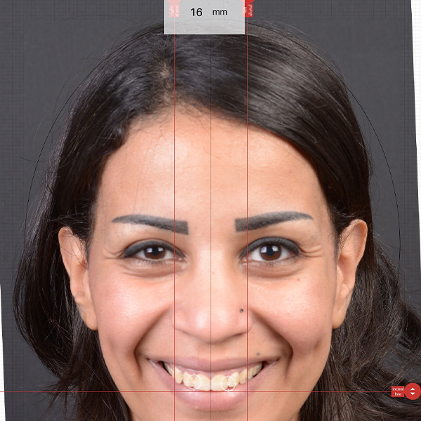 The patient’s face and esthetic zone were measured.